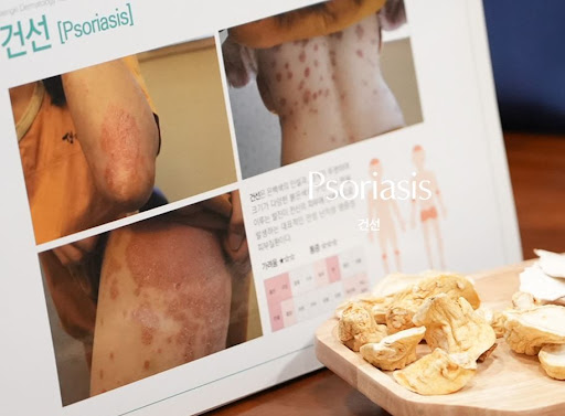 생기한의원 건선 정보, 판상형과 물방울형 차이 살펴보기